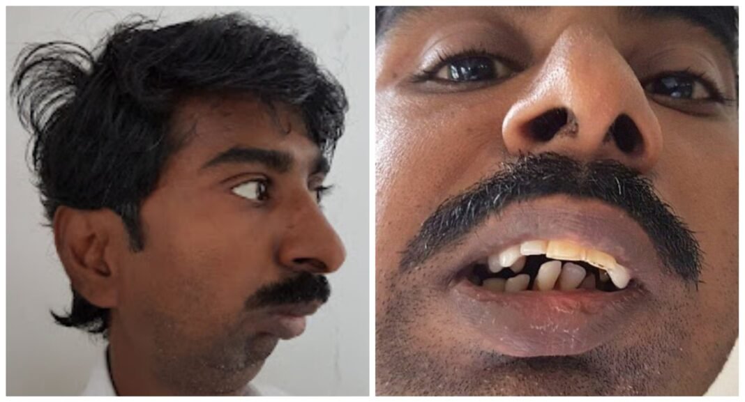 Rajendra Panchal: Pune Man With Fused Jaw Eats Solid Food After 38 Years