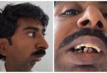 Rajendra Panchal: The Real Story Behind the Viral “Fused Jaw” Meme (2025) Rajendra Panchal: Pune Man With Fused Jaw Eats Solid Food After 38 Years