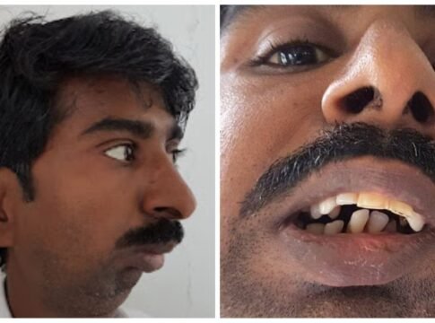 Rajendra Panchal: Pune Man With Fused Jaw Eats Solid Food After 38 Years