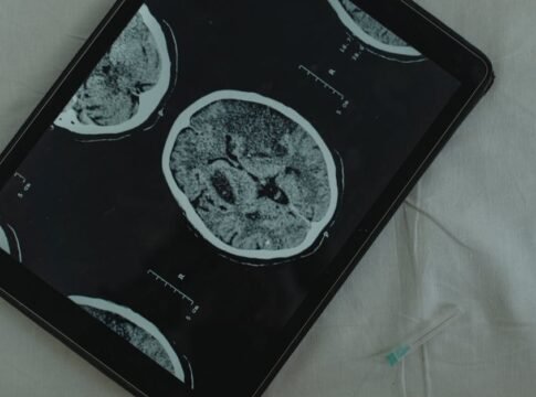 Close-up view of a brain CT scan displayed on a digital tablet with a medical needle beside it. Close-up view of a brain CT scan displayed on a digital tablet with a medical needle beside it.
