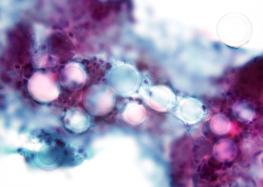 Parotid mass FNA. Granulomatous inflammation due to injection of filler material (microspheres). She had injectable facial dermal filler as a plastic cosmetic procedure, which rarely can cause local …