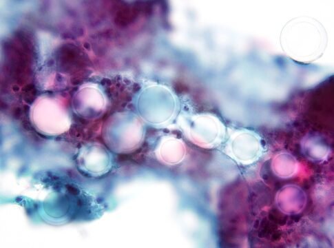 Parotid mass FNA. Granulomatous inflammation due to injection of filler material (microspheres). She had injectable facial dermal filler as a plastic cosmetic procedure, which rarely can cause local … Parotid mass FNA. Granulomatous inflammation due to injection of filler material (microspheres). She had injectable facial dermal filler as a plastic cosmetic procedure, which rarely can cause local …