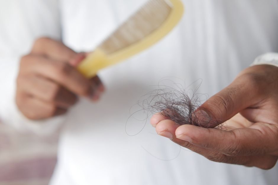 India: Young Adults Increasingly Seek Hair Transplants Amid Social Media Influence, Experts Advise Caution A detailed image showing hair loss with a comb in hand, symbolizing alopecia and related issues.