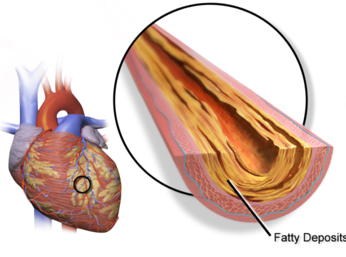 Coronary Artery Disease. See a full animation of this medical topic.