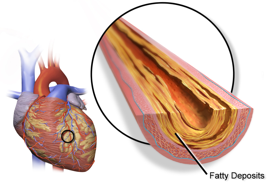 Delhi Study Links Iron Transport Protein to Early Heart Disease Diagnosis Coronary Artery Disease. See a full animation of this medical topic.